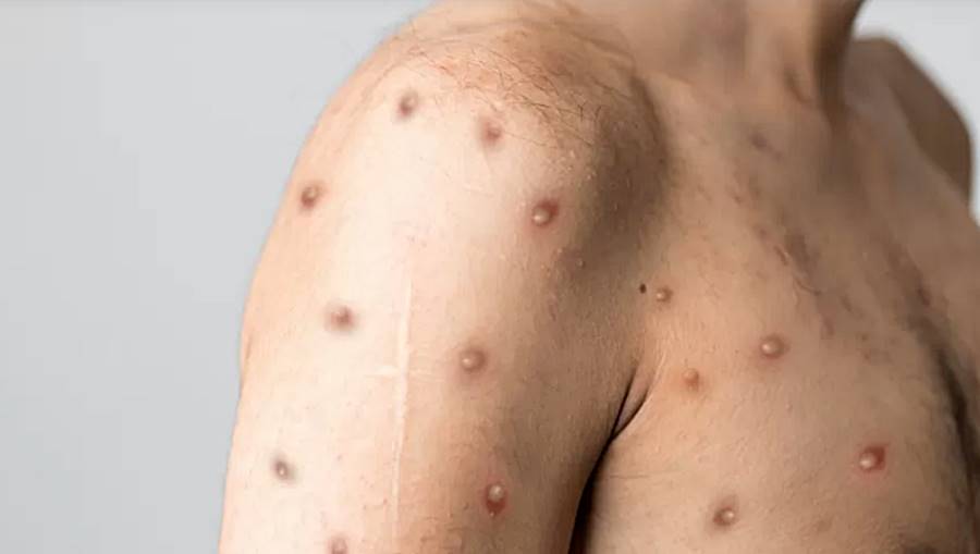 Secretaria de Saúde divulga caso de varíola dos macacos em Cataguases