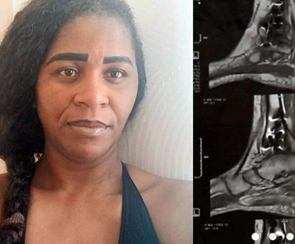 Moradora de Leopoldina busca ajuda para realizar segunda cirurgia após fratura na tíbia e fíbula