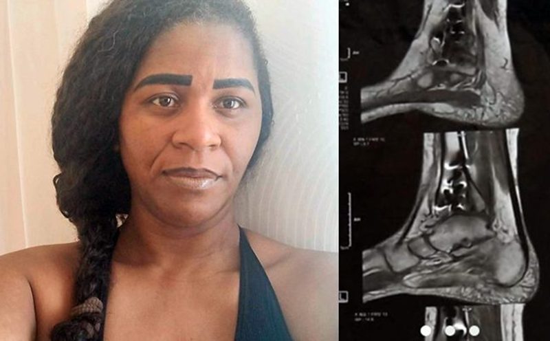 Moradora de Leopoldina busca ajuda para realizar segunda cirurgia após fratura na tíbia e fíbula
